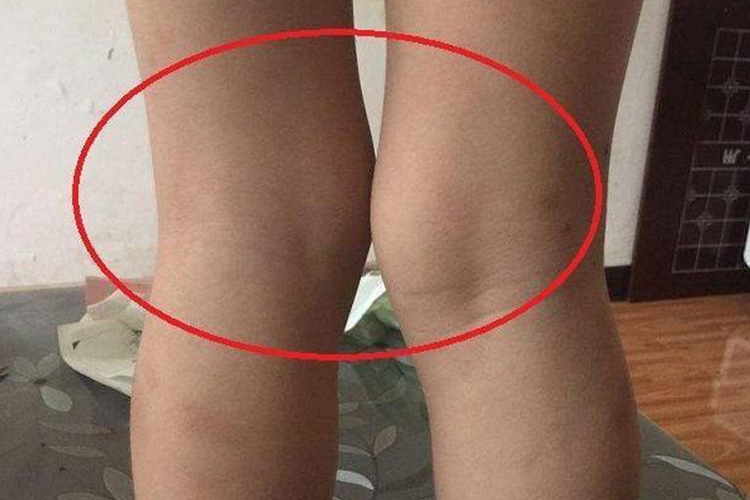 X型腿双膝摩擦图