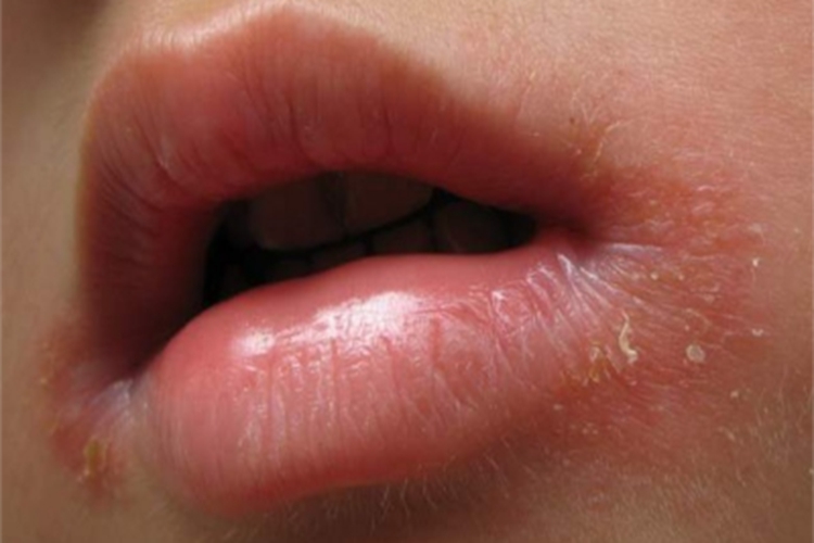 营养不良性口角炎口周症状图