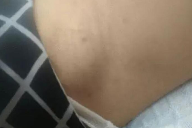 艾滋病腋下淋巴结肿大图