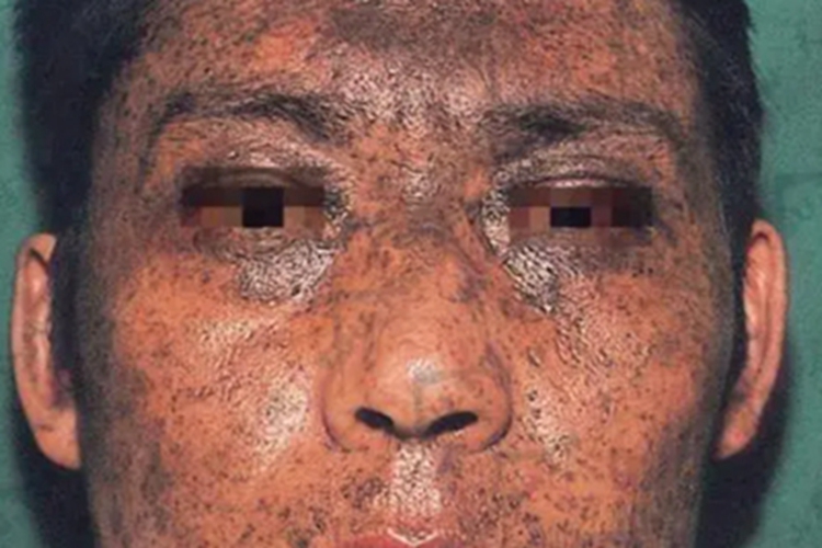 意外粉粒沉着病面部斑图 意外粉粒沉着病面部斑图