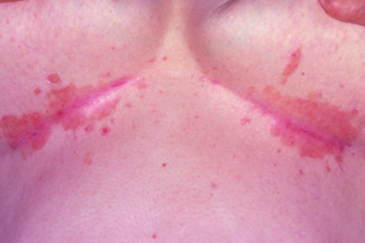 急性乳房湿疹乳房症状图 急性乳房湿疹乳房症状图