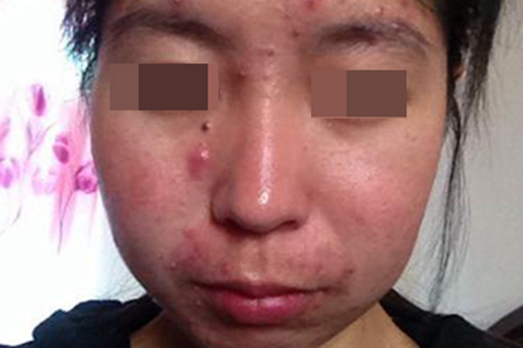 女性二期梅毒面部疙瘩图