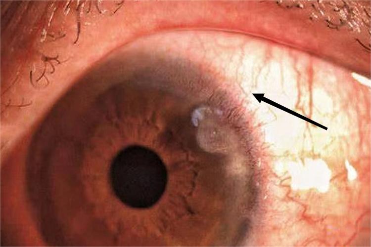 放射及束状新生血管图 放射及束状新生血管图