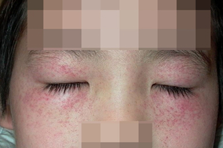 血小板减少性紫癜症状图