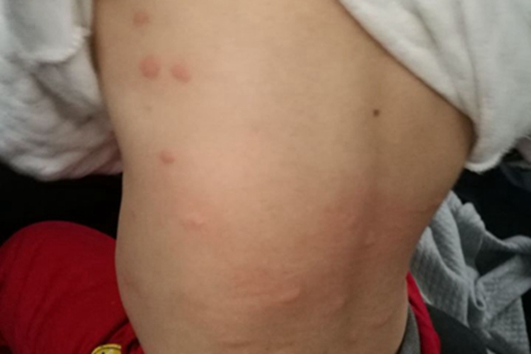 跳蚤叮咬症状图