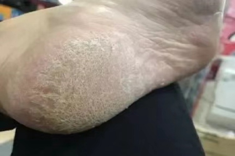 更年期角皮症脚后跟皮肤增厚图