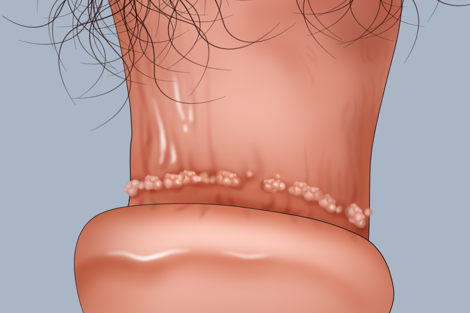 尖锐湿疣冠状沟肉粒图