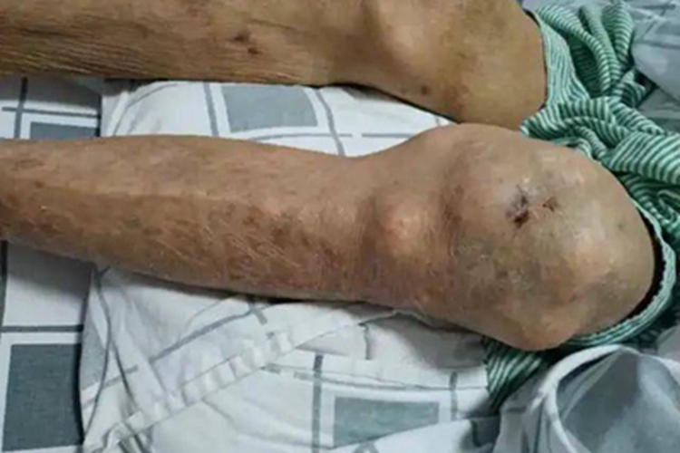 痛风膝盖症状图 痛风膝盖症状图