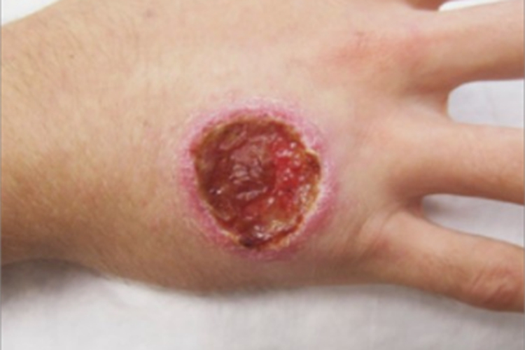 皮肤利什曼病手背发红图