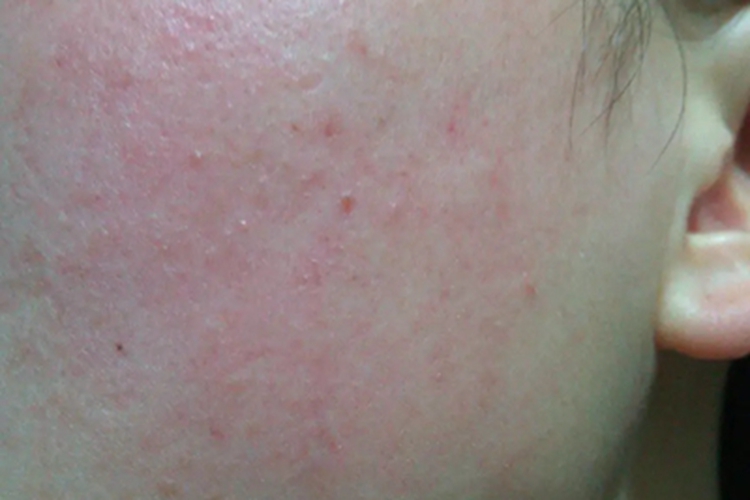 类癌综合征面部丘疹图