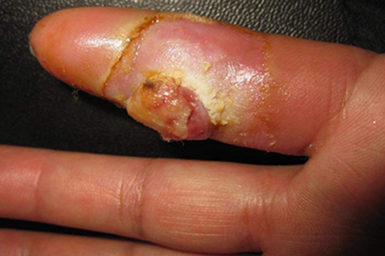 脓性指头炎手指溃疡图 脓性指头炎手指溃疡图