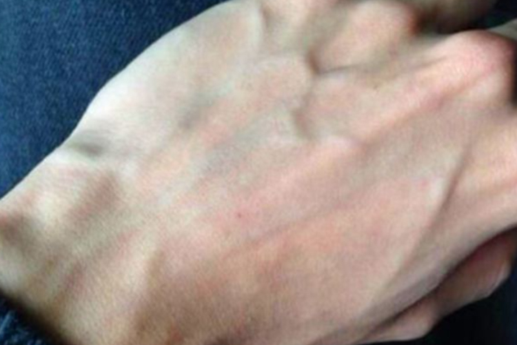 手背血管正常突出不太明显图