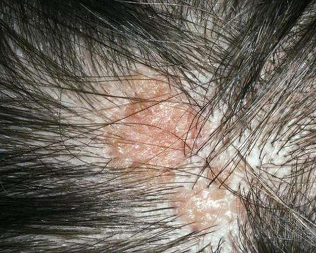 头虱引发的丘疹图