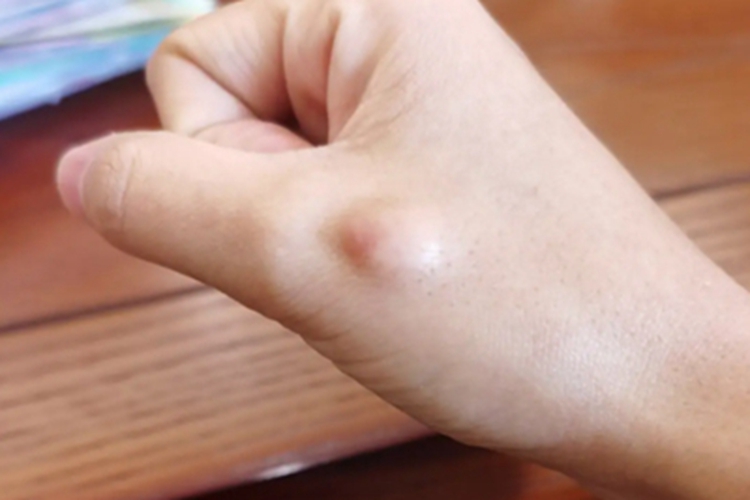 脂肪瘤手背包块图