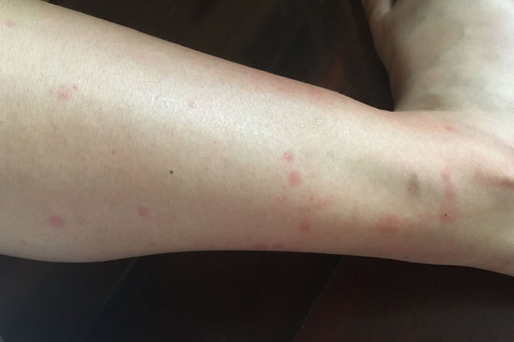 吃马蜂过敏特应性皮炎图