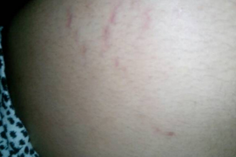 妊娠纹肚子上有红色的纹图