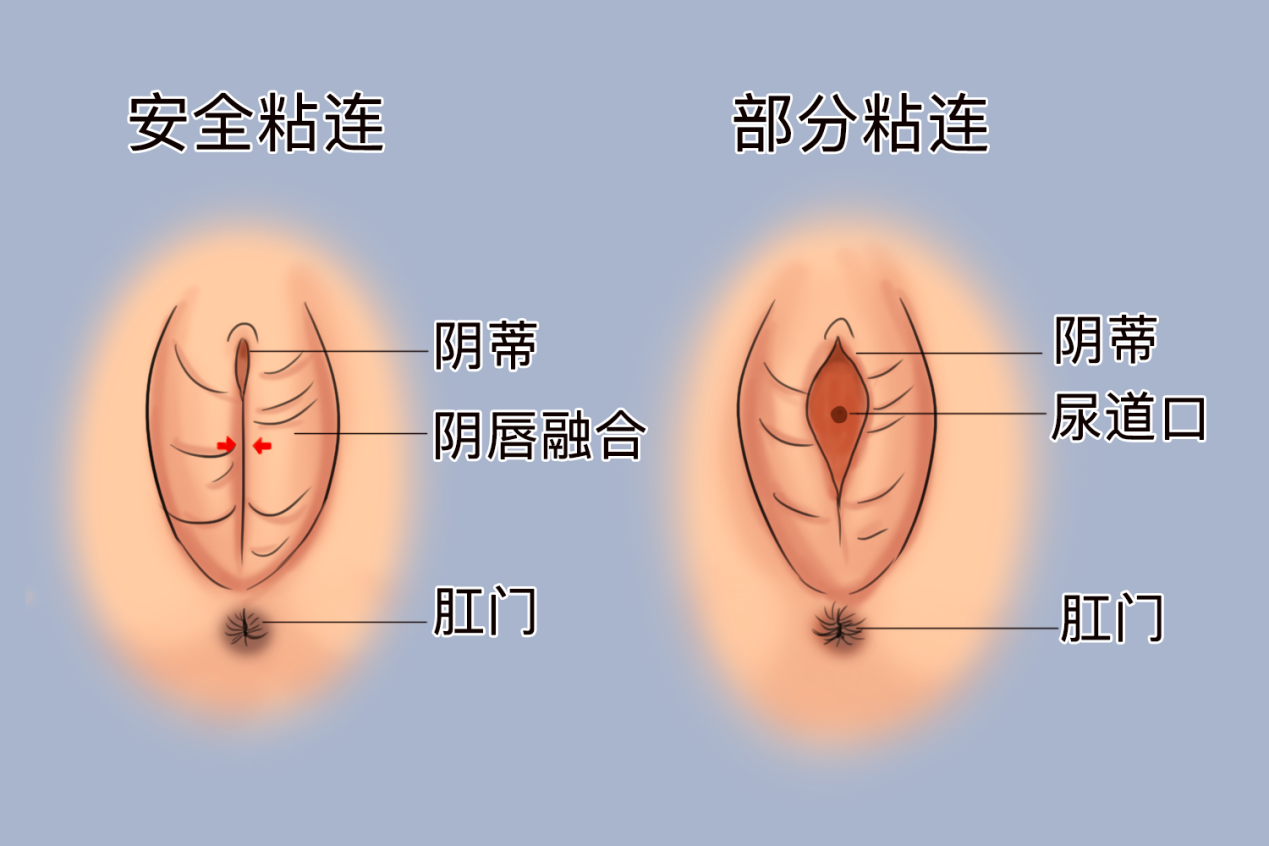 婴儿下面粘连图片图片