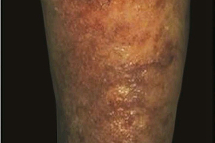 慢性期硬化性脂膜炎症状图 慢性期硬化性脂膜炎症状图