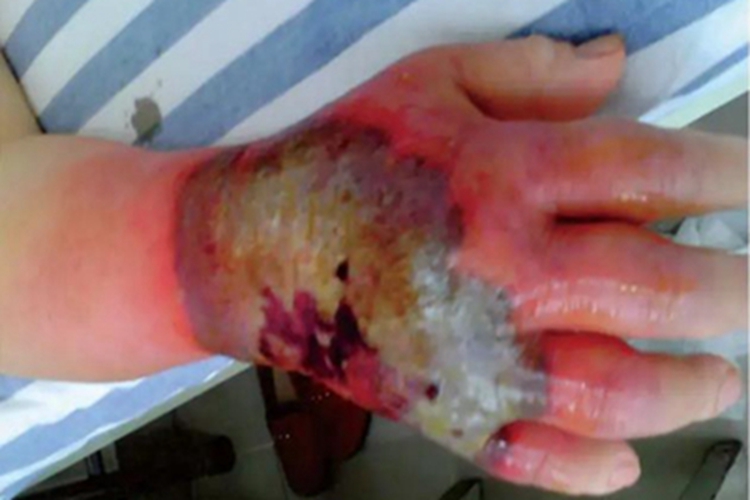 新生儿皮下坏疽症状图