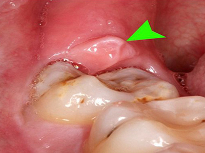 阻生智齿发炎图片