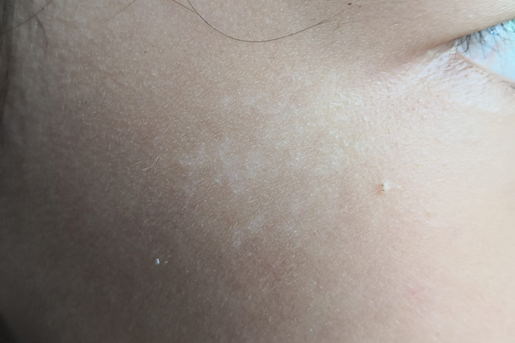 贫血痣小儿白斑初期图