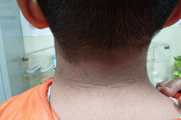 颈部色素沉着图