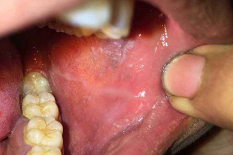 扁平苔藓口腔黏膜白色条纹图 扁平苔藓口腔黏膜白色条纹图