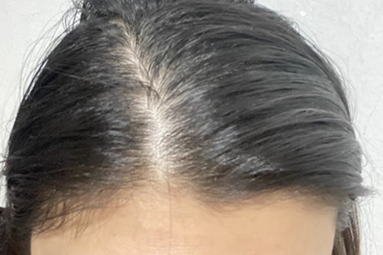 雄激素性脱发头顶发缝增宽图 雄激素性脱发头顶发缝增宽图