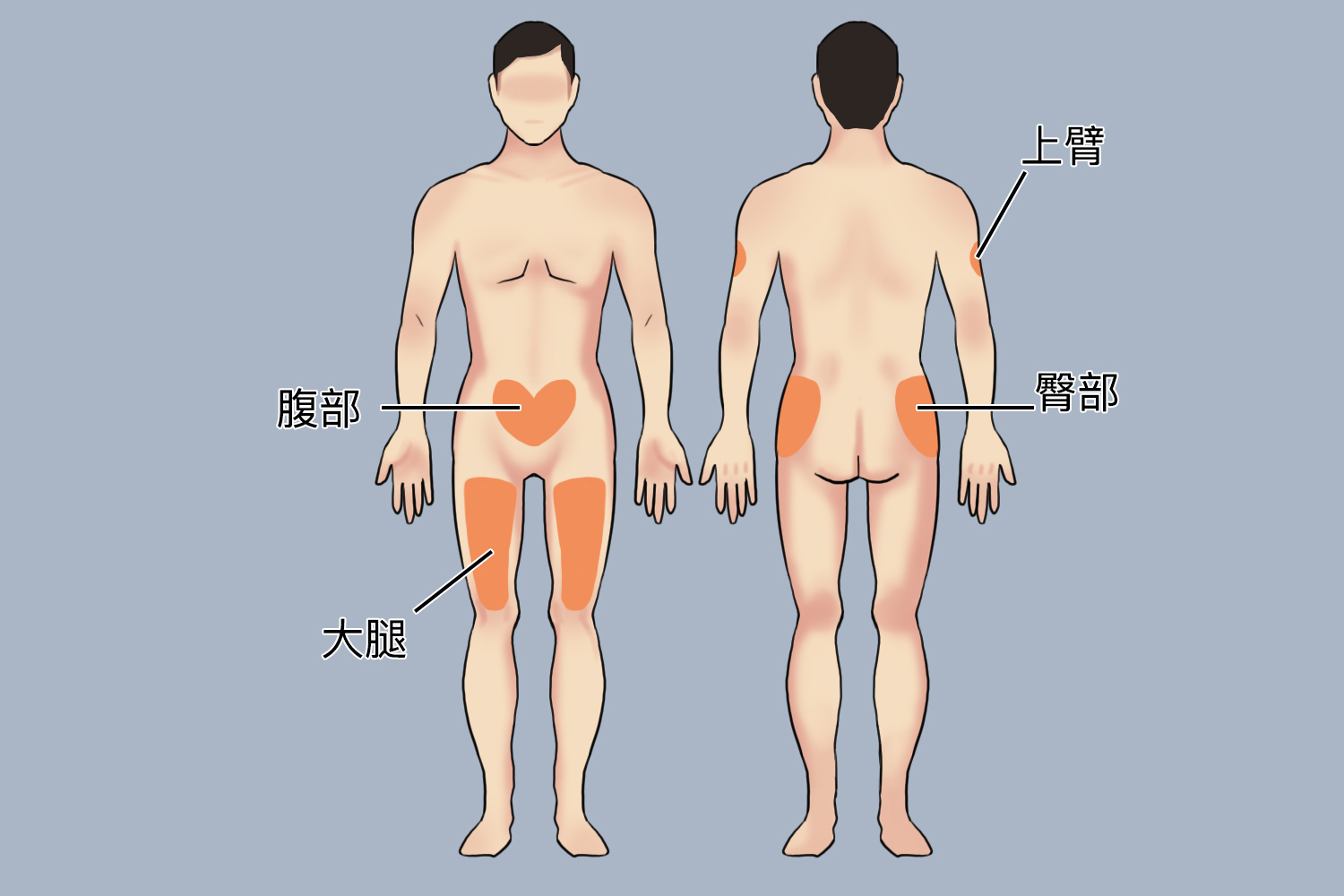 糖尿病打针部位图