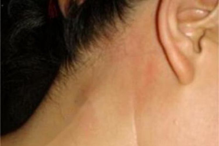 鼻咽癌脖子后面有硬块图 鼻咽癌脖子后面有硬块图