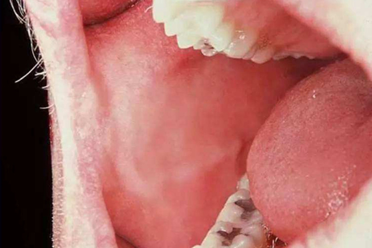 正常人口腔侧壁图