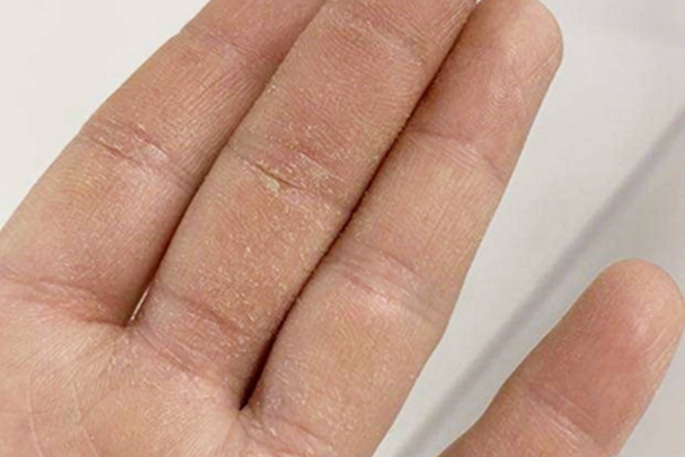 掌跖角皮症手指症状图