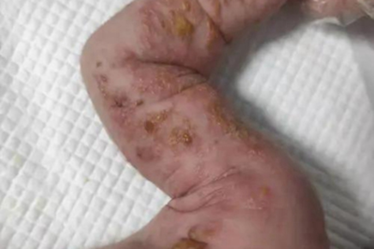 色素失调症胳膊症状图