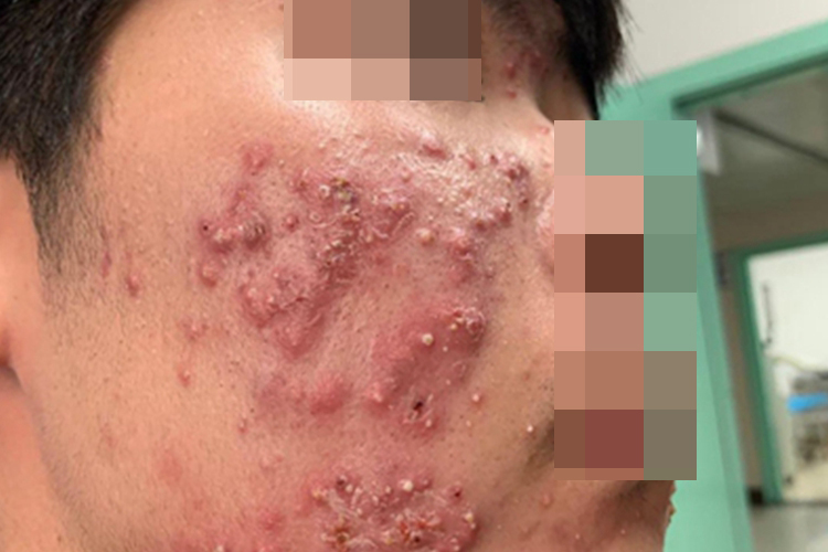 暴发性痤疮面部大片结节图 暴发性痤疮面部大片结节图