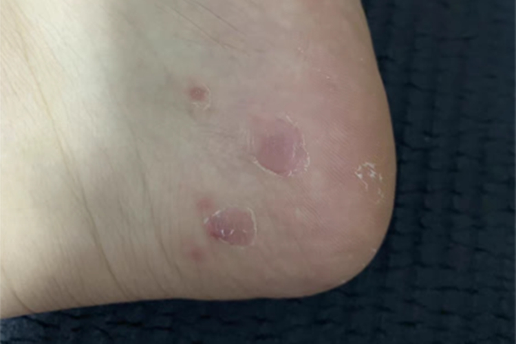脚气水泡病症是什么模样的呢？求解