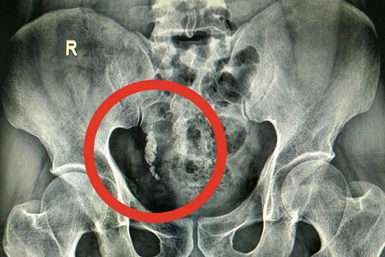 右侧输尿管下段结石影像图