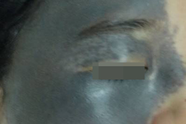 太田痣面部斑图