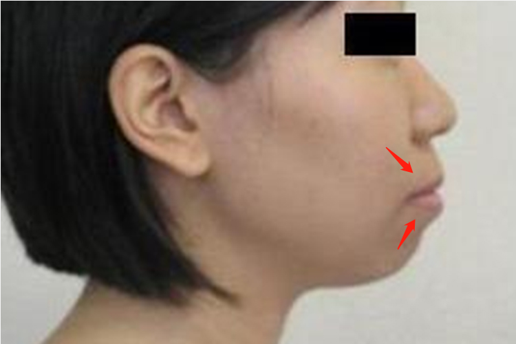 双颌前突导致严重嘴凸图 双颌前突导致严重嘴凸图