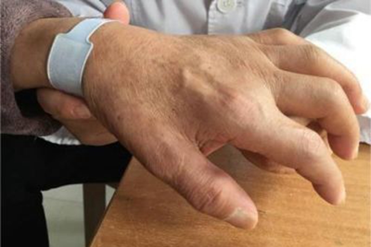 肩手综合征疼痛期手指症状图