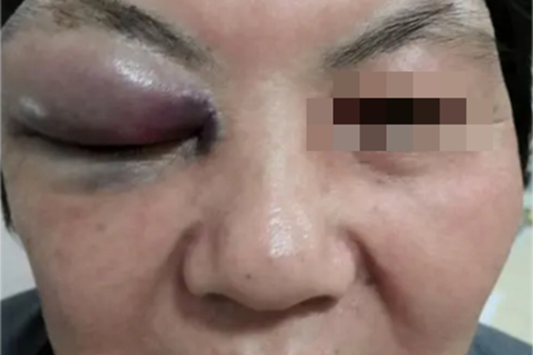 眼眶血肿症状图 眼眶血肿症状图