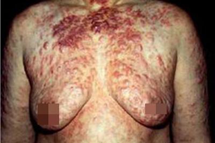 内脏利什曼病胸部大红疙瘩图