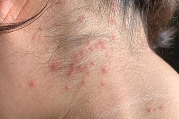 成人痒疹侧颈小疙瘩图 成人痒疹侧颈小疙瘩图