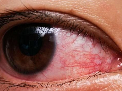 滤泡性结膜炎白眼球有好多红血丝图