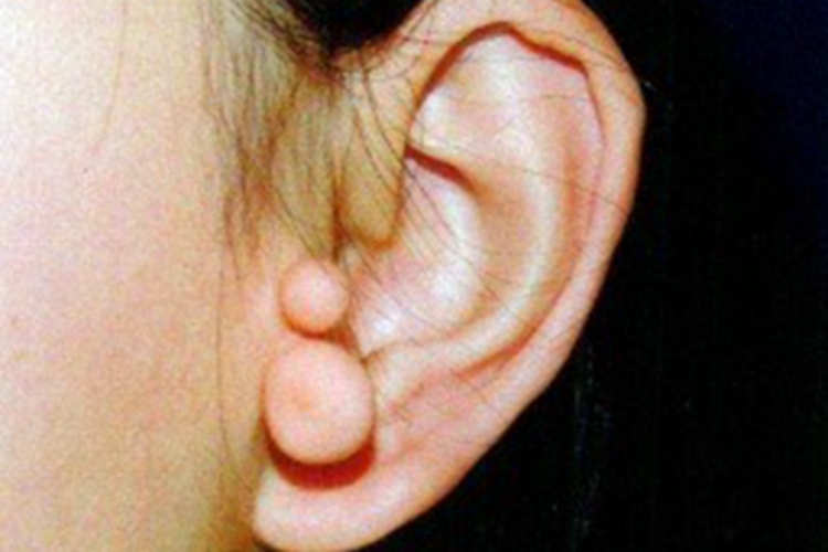副耳耳前症状图