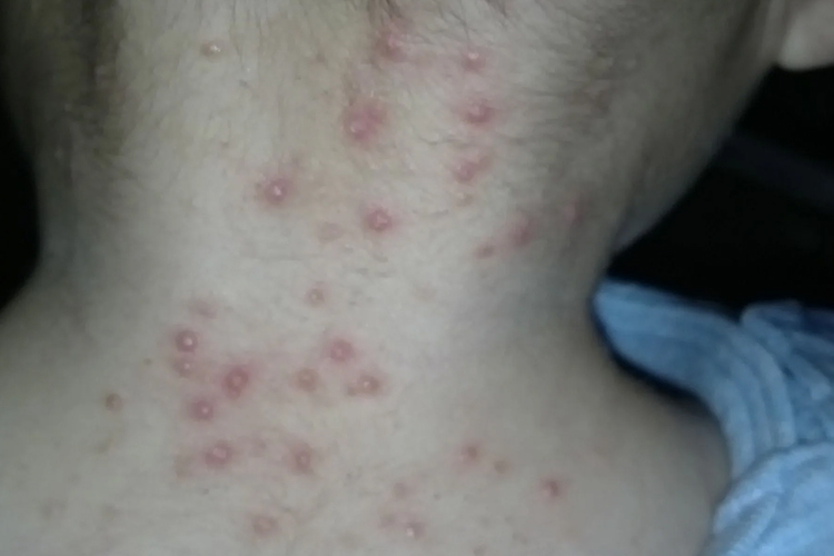 宝宝脖子急性湿疹图 宝宝脖子急性湿疹图