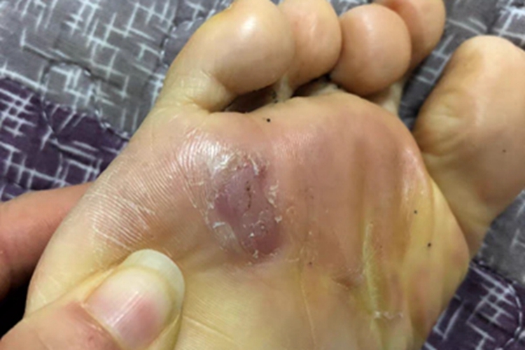 胼胝脚底有紫色和黄色硬块图 胼胝脚底有紫色和黄色硬块图