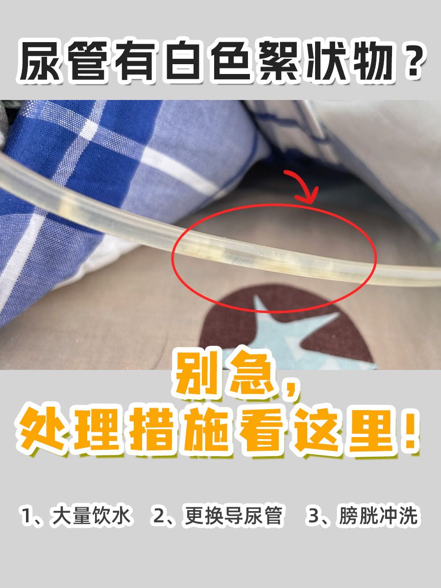 尿管有白色絮状物？别急，处理措施看这里！