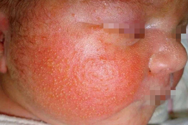 新生儿中毒性红斑症状图