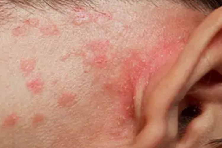 急性湿疹耳后红斑图