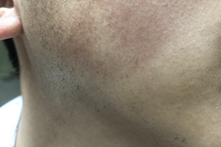 寻常型鱼鳞病面部皮肤颜色加深图 寻常型鱼鳞病面部皮肤颜色加深图